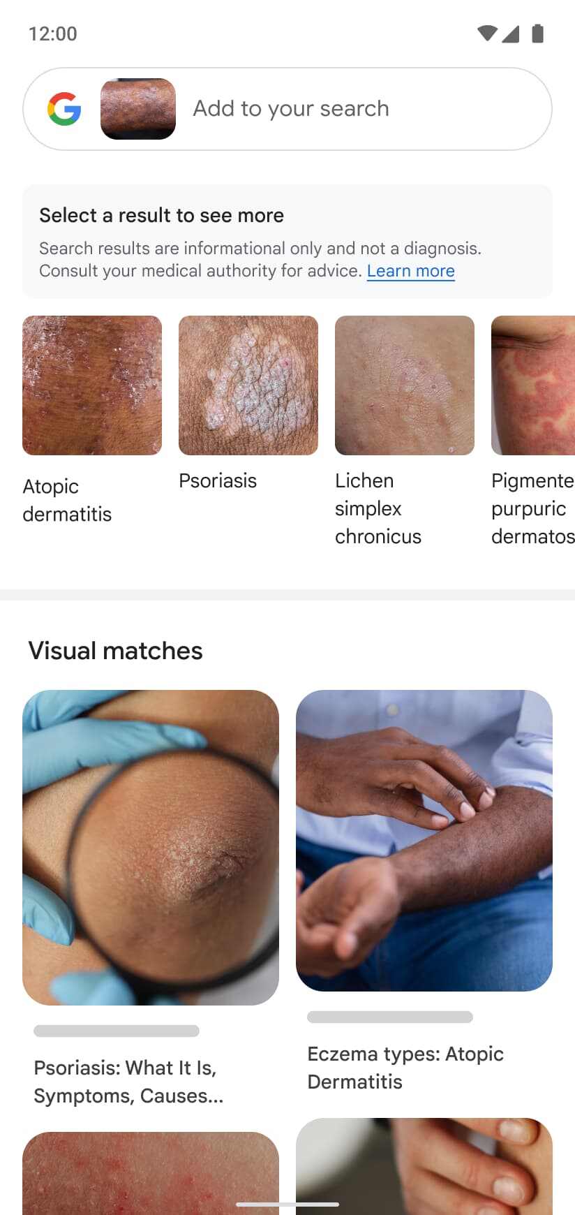 Google Lens to identify skin conditions 